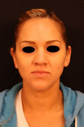 Revision Rhinoplasty with septal perforation repair