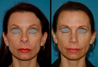 Revision Rhinoplasty (open)