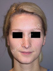Rhinoplasty