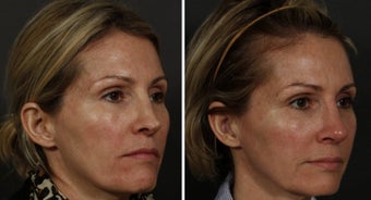 Revision Rhinoplasty and Sculptra
