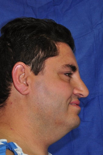 Rhinoplasty