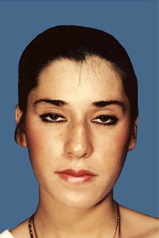 Rhinoplasty