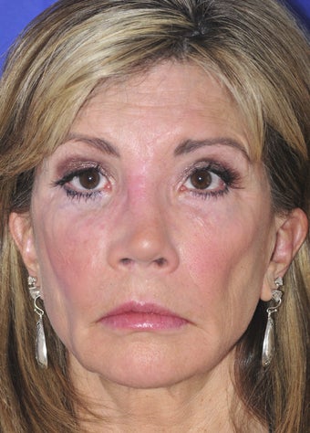 Revision Rhinoplasty