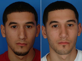 Nose Surgery (Revision Rhinoplasty)