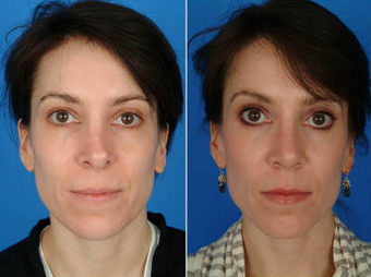 Revision Rhinoplasty