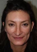 Rhinoplasty