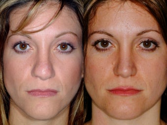 Revision rhinoplasty