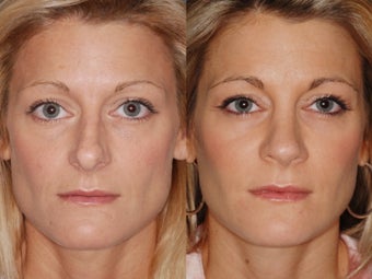 Revision rhinoplasty