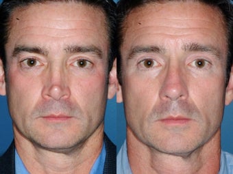 Revision rhinoplasty