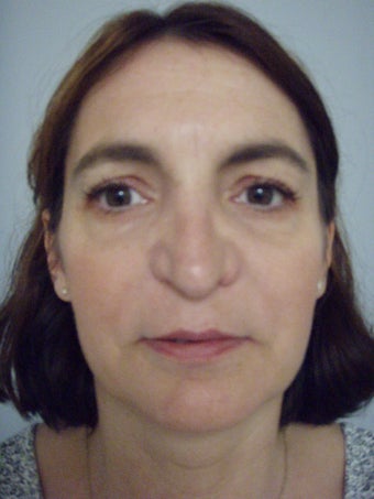 4th Revision Rhinoplasty