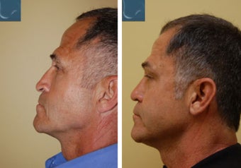 Revision Rhinoplasty