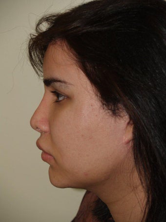 Revision Rhinoplasty