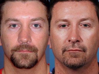 Revision rhinoplasty
