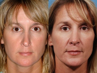 Revision rhinoplasty
