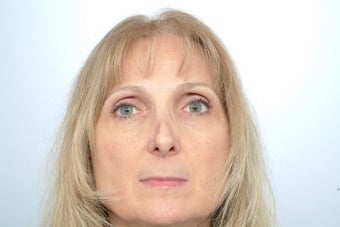Revision Rhinoplasty