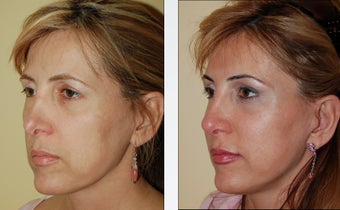 Revision Rhinoplasty