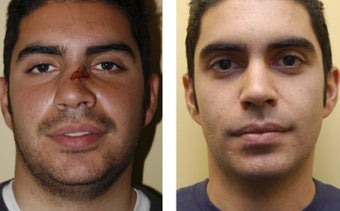 Revision rhinoplasty