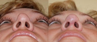 Revision rhinoplasty