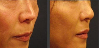 Asian Rhinoplasty