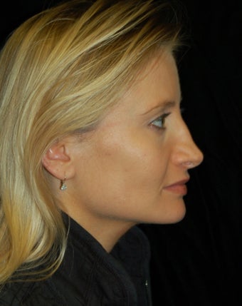 Revision Rhinoplasty