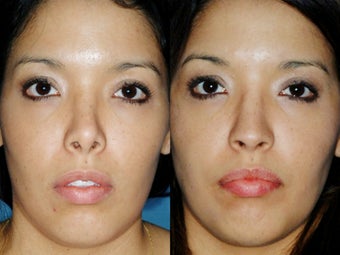 Revision rhinoplasty