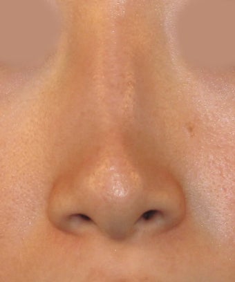 Revision Rhinoplasty