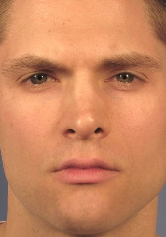 Revision Rhinoplasty