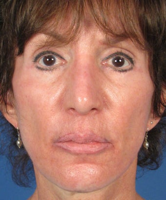 Revision Rhinoplasty