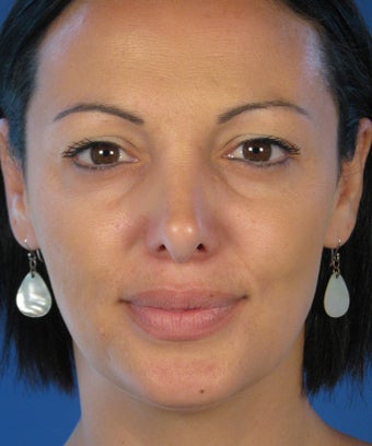 Revision Rhinoplasty