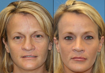 Cleft Palate Nasal Surgery