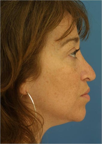 Revision Rhinoplasty