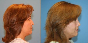 Revision Rhinoplasty