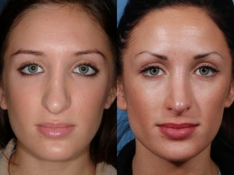 Revision rhinoplasty