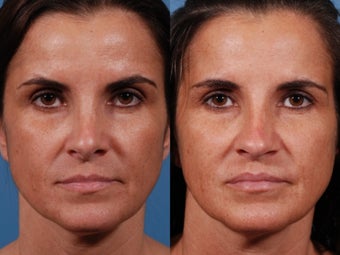 Revision rhinoplasty