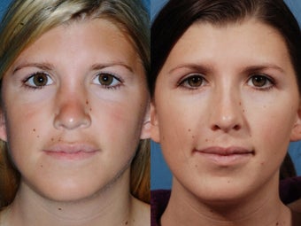 Revision rhinoplasty