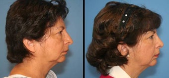 revision rhinoplasty