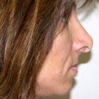 Revision Rhinoplasty