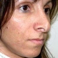 Revision Rhinoplasty
