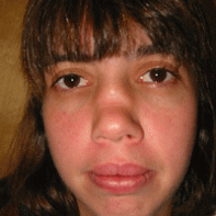 Revision Rhinoplasty