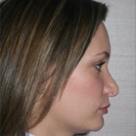 Revision Rhinoplasty
