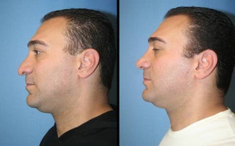 male rhinoplasty