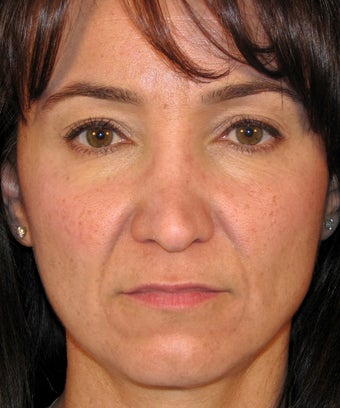 Revision Rhinoplasty
