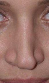 Revision Rhinoplasty