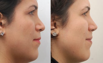 Revision Rhinoplasty