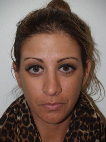 Revision Rhinoplasty