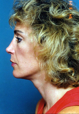Revision Rhinoplasty