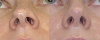 Revision Rhinoplasty