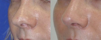Revision Rhinoplasty