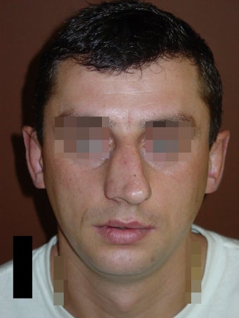 Crooked nose correction