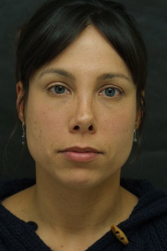 Revision Rhnioplasty
